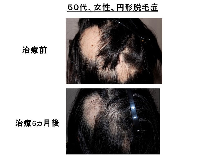 円形脱毛症　病院